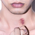 Hickey Removal Treatment - SKINFUDGE Aesthetics | Painless, No Side Effects, Natural Looking Results