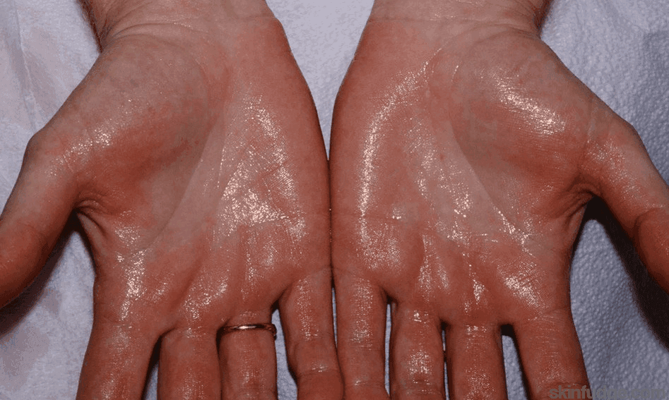 Hyperhidrosis Clinic - SKINFUDGE Aesthetics | Painless, No Side Effects, Natural Looking Results