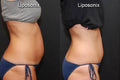 Liposuction Cost in Lahore Pakistan - SKINFUDGE Aesthetics | Painless, No Side Effects, Natural Looking Results
