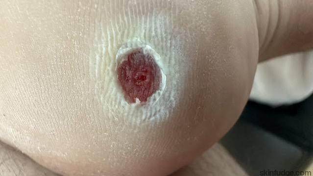 Wart Removal Treatment (Non-Genital) - SKINFUDGE Aesthetics | Painless, No Side Effects, Natural Looking Results