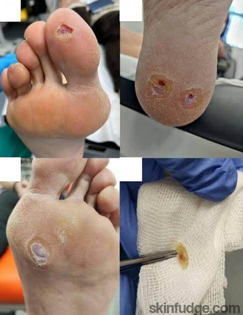 Wart Removal Treatment (Non-Genital) - SKINFUDGE Aesthetics | Painless, No Side Effects, Natural Looking Results