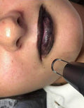 CarboLip: The Black Lip Charcoal Laser Treatment - SKINFUDGE Aesthetics | Painless, No Side Effects, Natural Looking Results