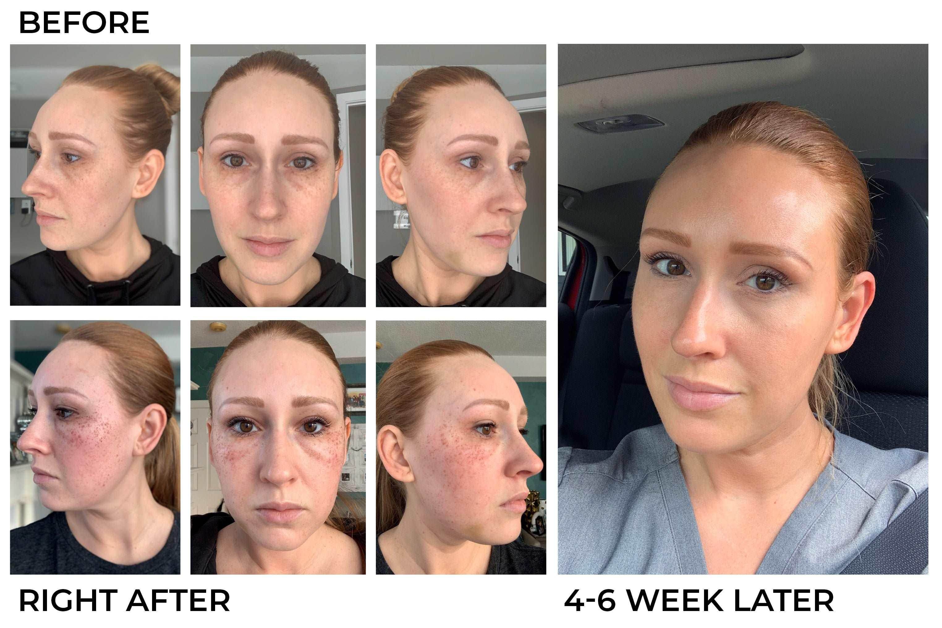Photofacial - SKINFUDGE Aesthetics | Painless, No Side Effects, Natural Looking Results