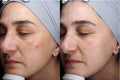 Spectra Peel Laser Treatment - SKINFUDGE Aesthetics | Painless, No Side Effects, Natural Looking Results