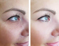 Eye Wrinkle Treatment - SKINFUDGE Aesthetics | Painless, No Side Effects, Natural Looking Results