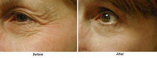 The Madonna Eye Lift - SKINFUDGE Aesthetics | Painless, No Side Effects, Natural Looking Results