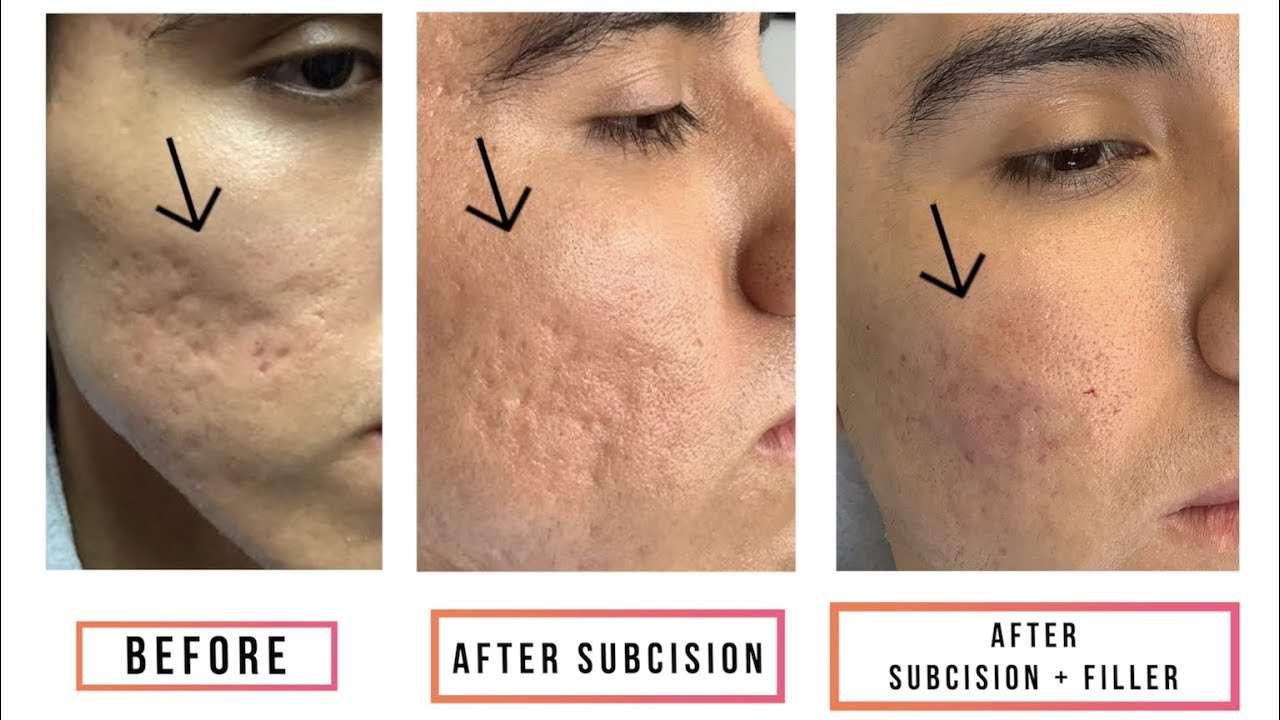 Acne Scars Subcision Treatment in Lahore-SKINFUDGE