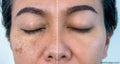 Microneedling (Mesotherapy) PRP Treatment for Face Melasma - SKINFUDGE Aesthetics | Painless, No Side Effects, Natural Looking Results