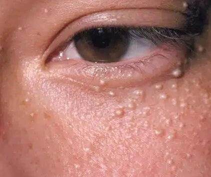 Milia: Treatment Options - SKINFUDGE Aesthetics | Painless, No Side Effects, Natural Looking Results