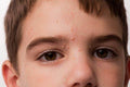 Molluscum Contagiosum in Children - SKINFUDGE Aesthetics | Painless, No Side Effects, Natural Looking Results