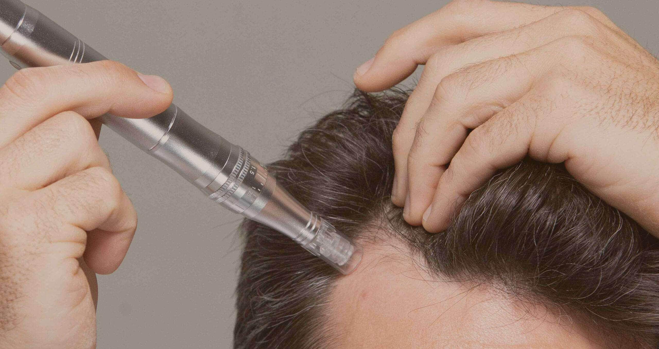Dutasteride Microneedling Scalp Treatment - SKINFUDGE Aesthetics | Painless, No Side Effects, Natural Looking Results