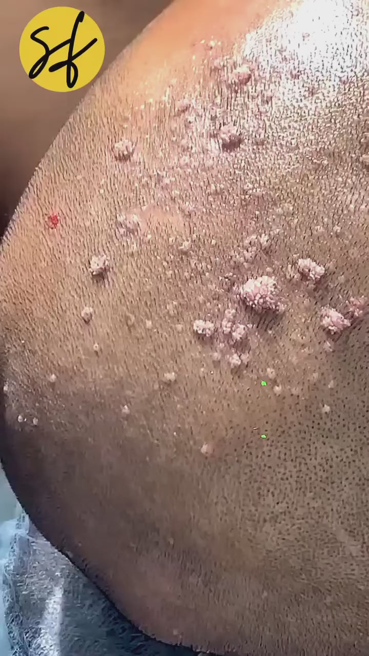 Wart Removal Treatment (Non-Genital)