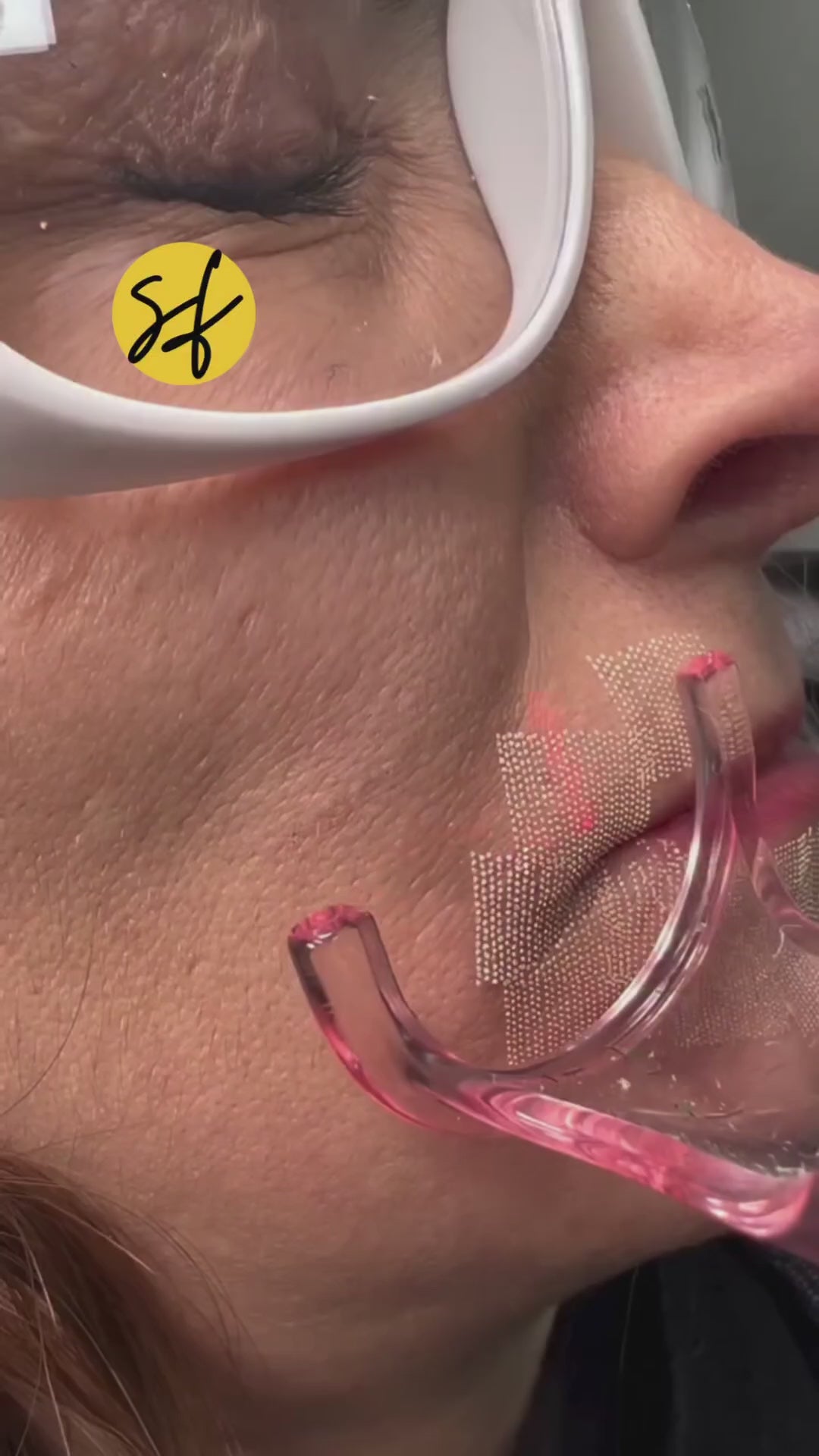 Perioral CO2 Laser Lip Lines Eraser