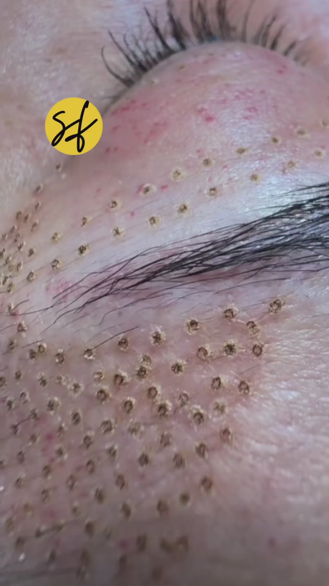 Non-surgical Blephroplasty