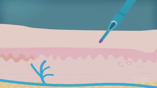 Tattoo Laser Removal