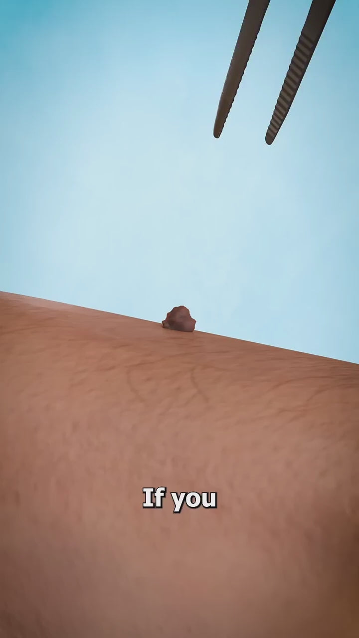 Skin Tag Removal