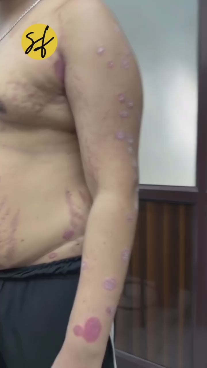 Psoriasis Clinic