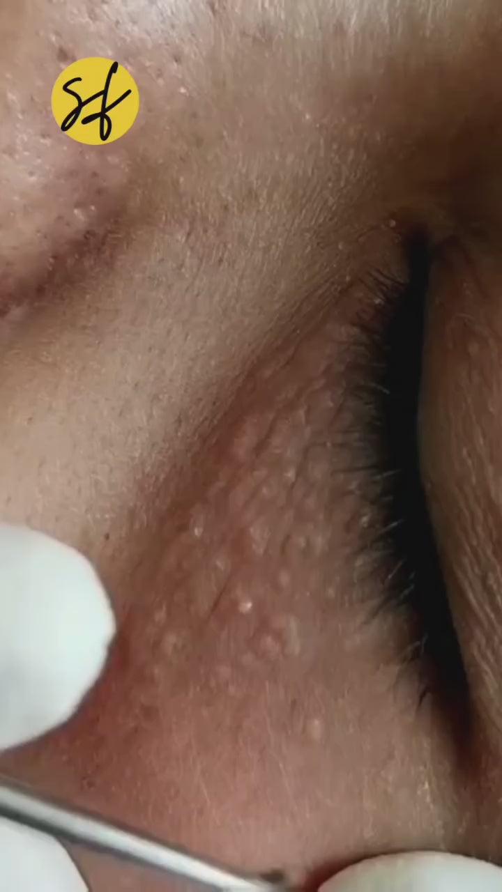 Syringoma Removal
