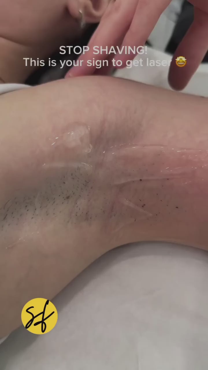 Underarms/Armpits Laser Hair Removal - Female