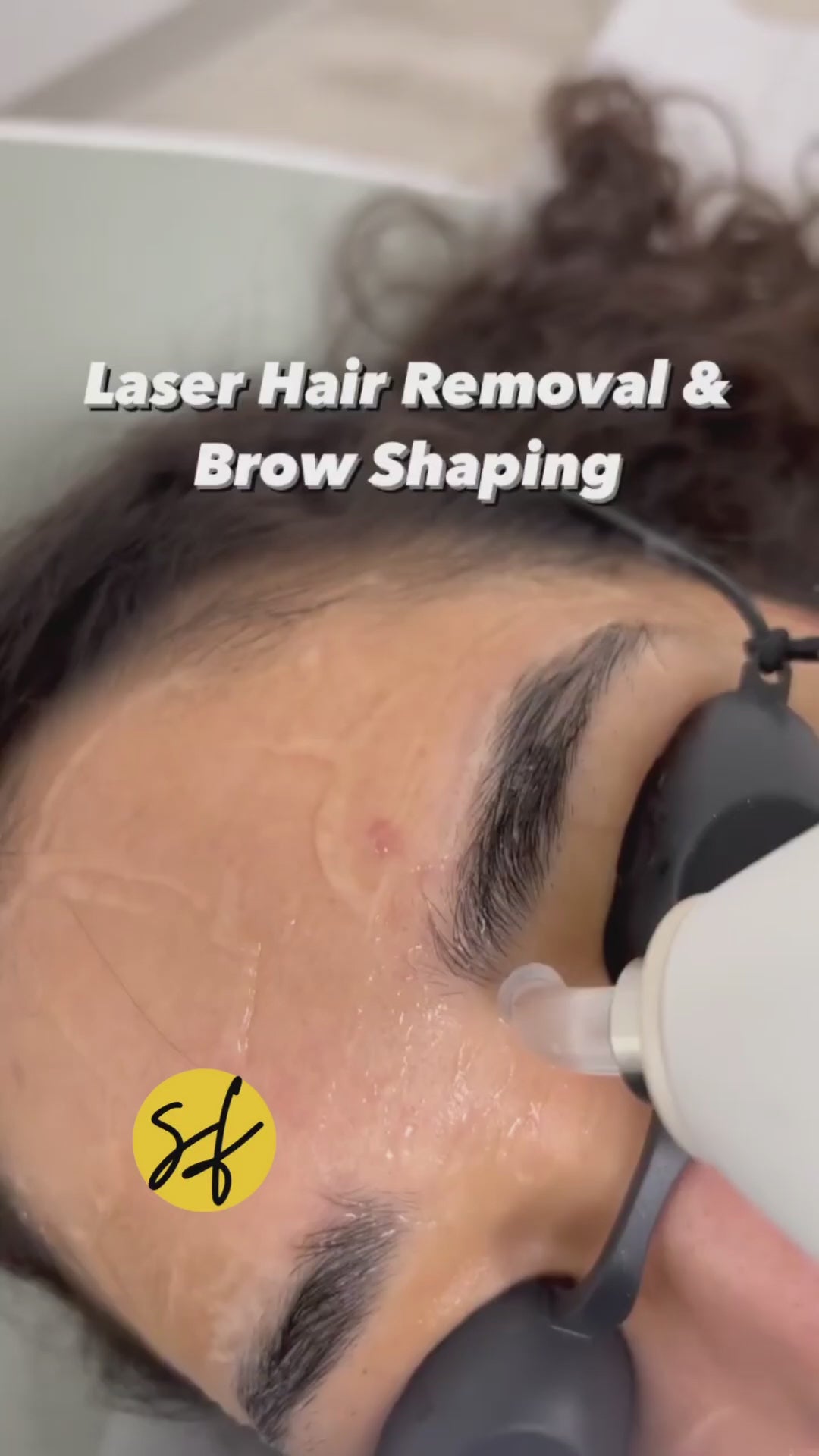 Laser Eyebrow Shaping