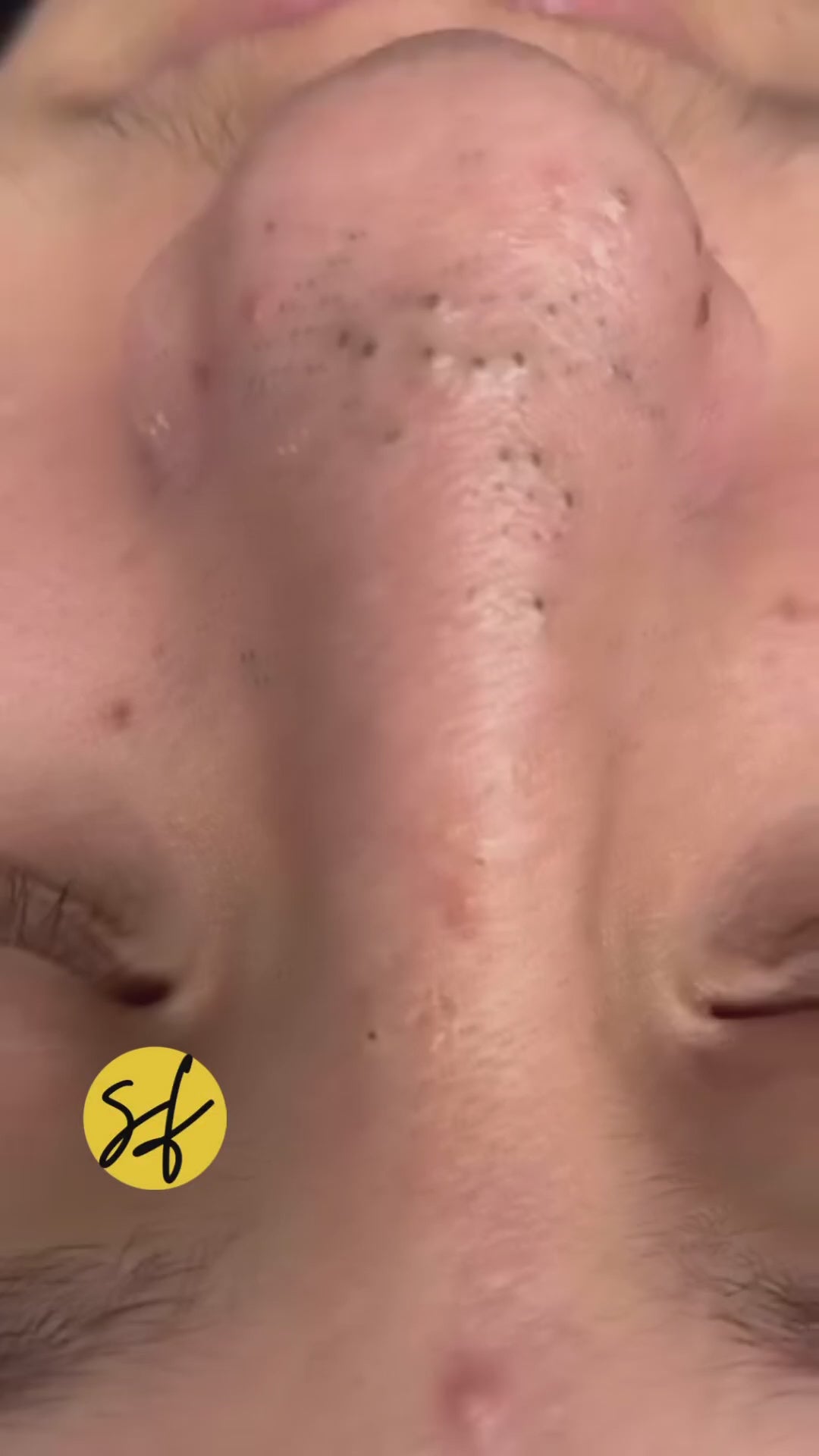 Nose Blackhead Removal Instant