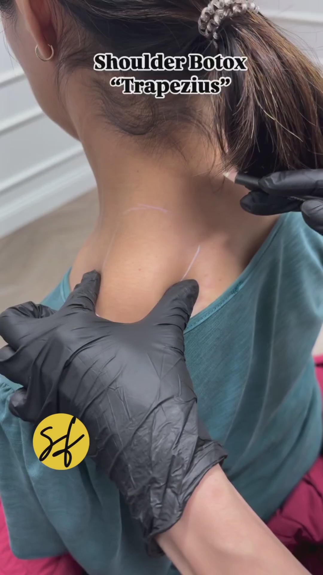 Trapezius Botox in Lahore – Slimmer Shoulders & Relaxed Muscles