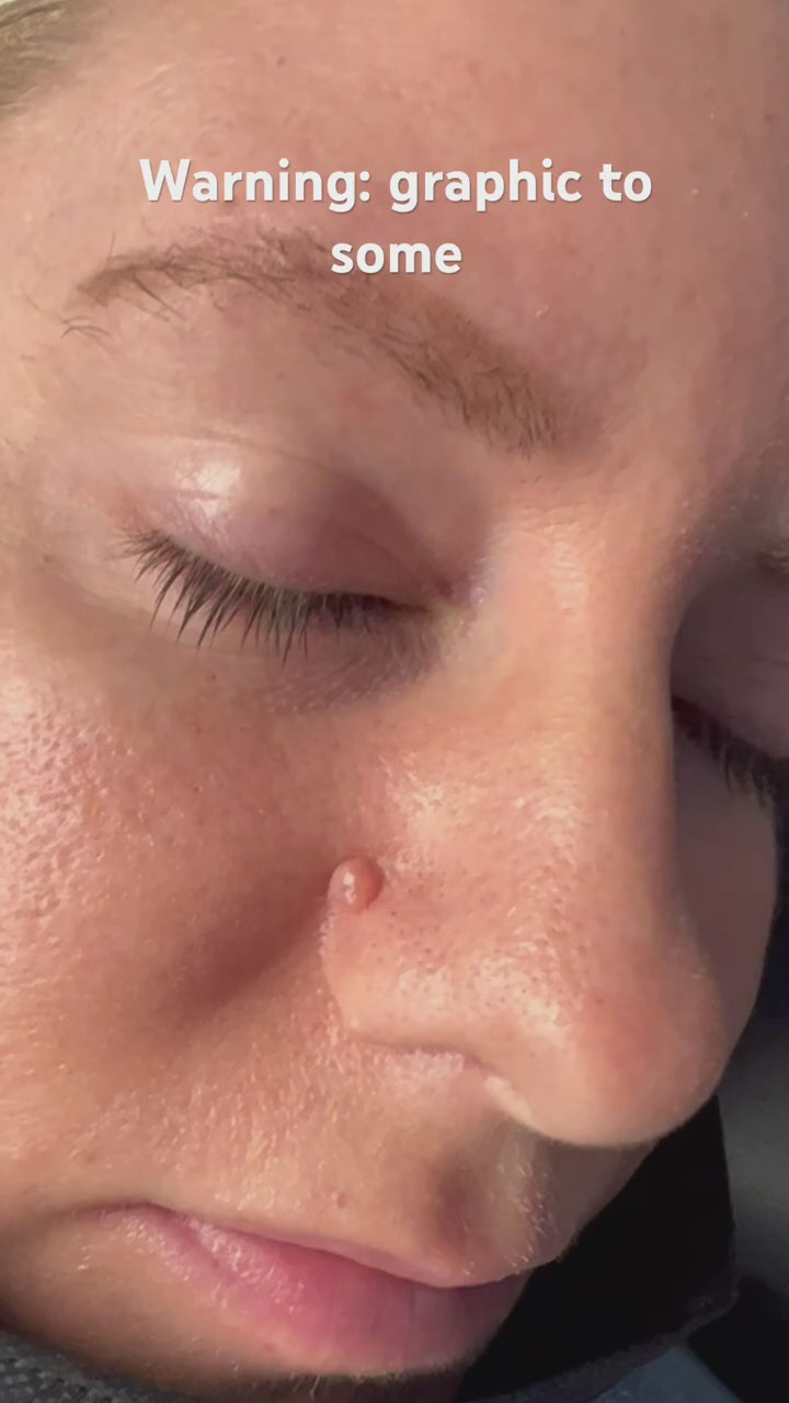 Mole Removal