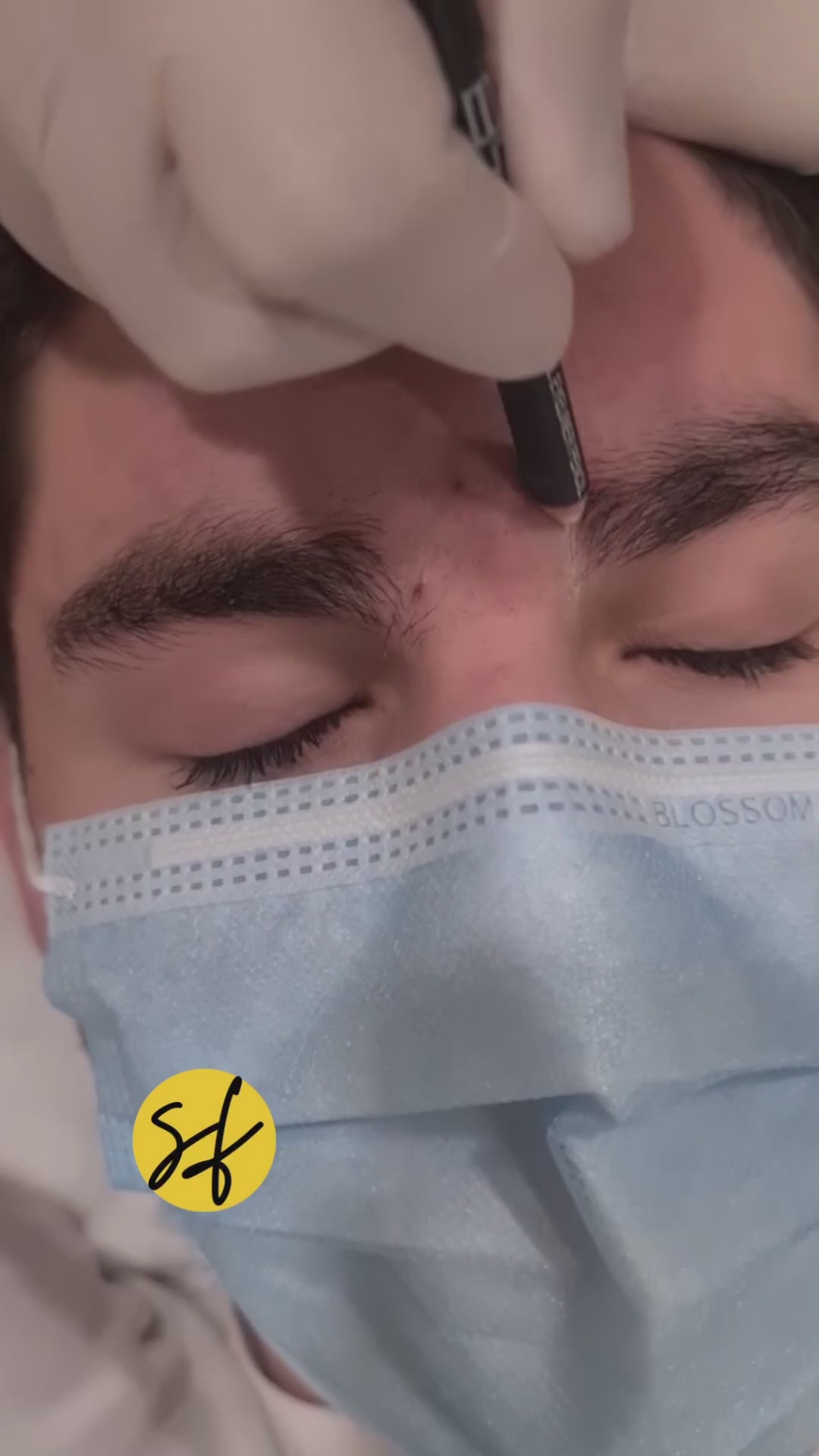 Unibrow Laser Hair Removal