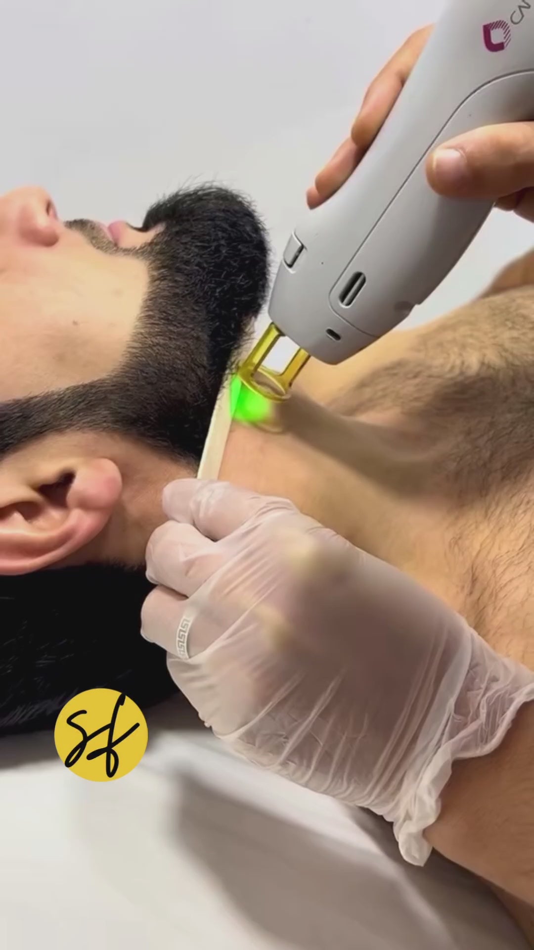 Beard Line Laser Hair Removal