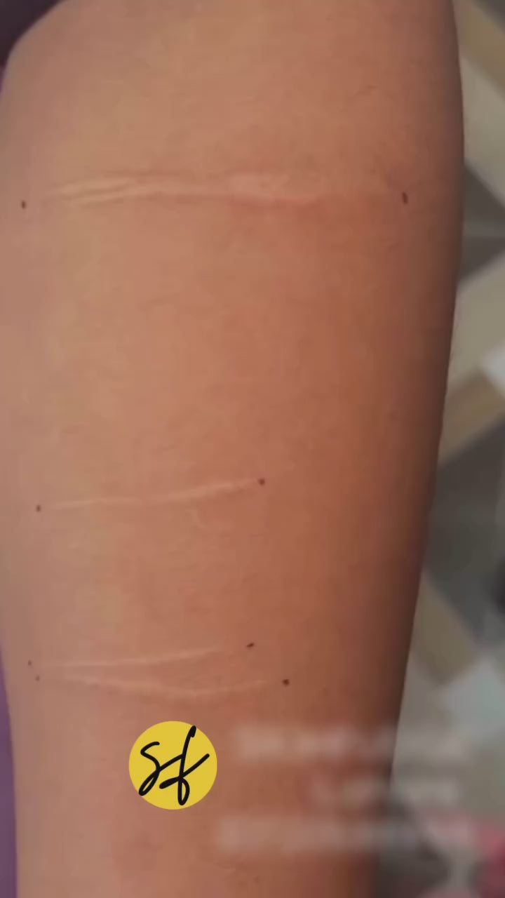 Self-Harm, Injury Marks Arm Scar Treatment with Fotona CO2 Laser