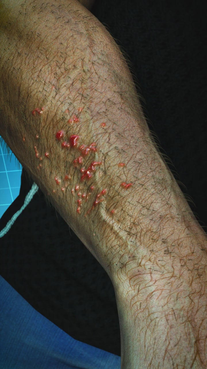 Scabies Consultation