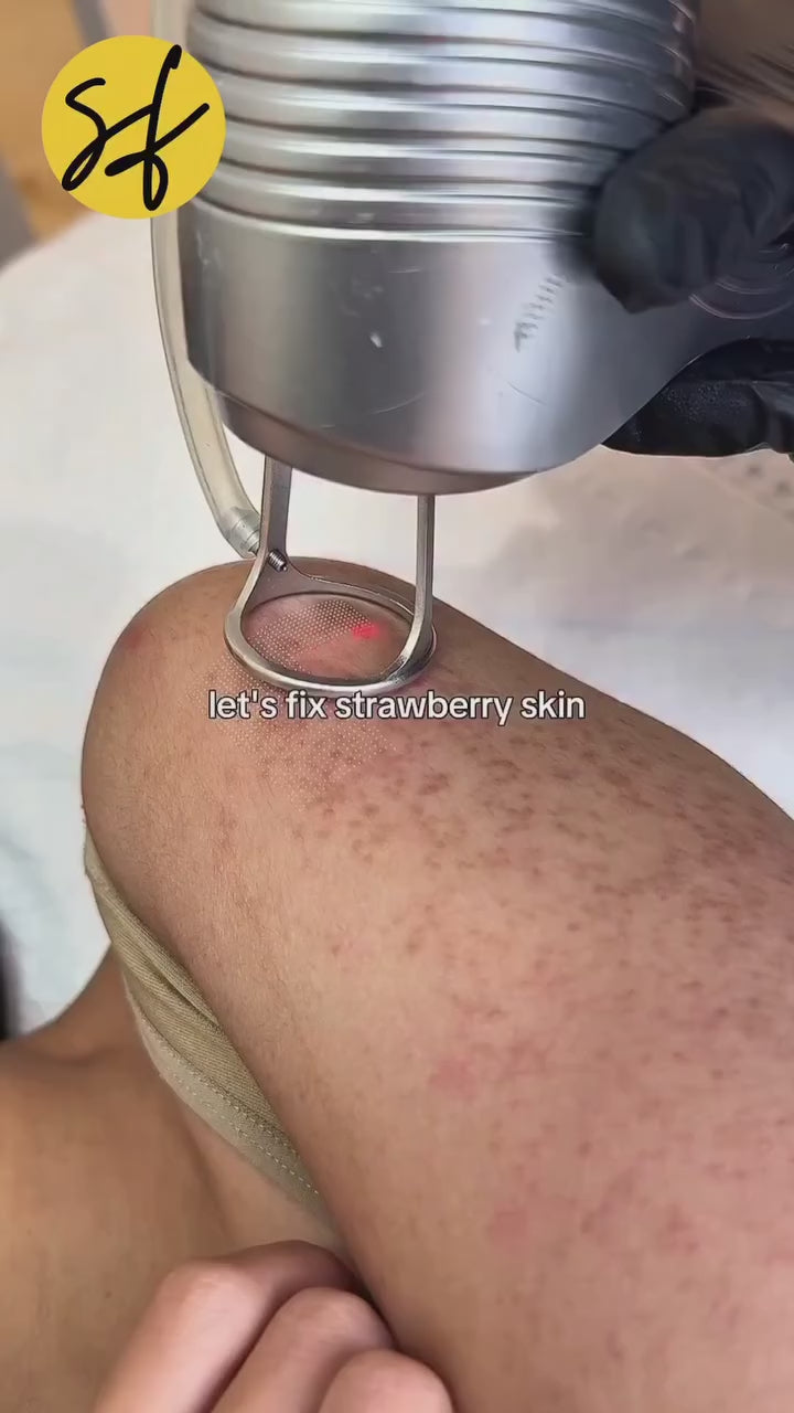 Keratosis Pilaris Treatment
