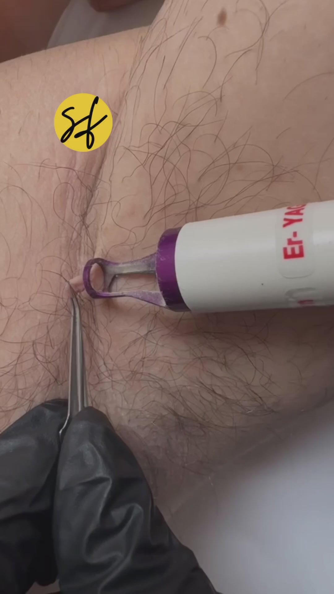 Skin Tag Removal