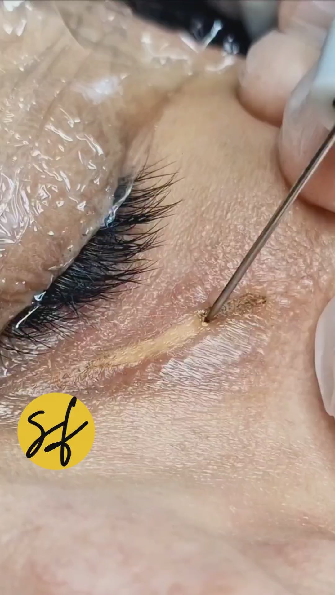 Xanthelasma (کولیسٹرول پیچ کو ہٹانا)