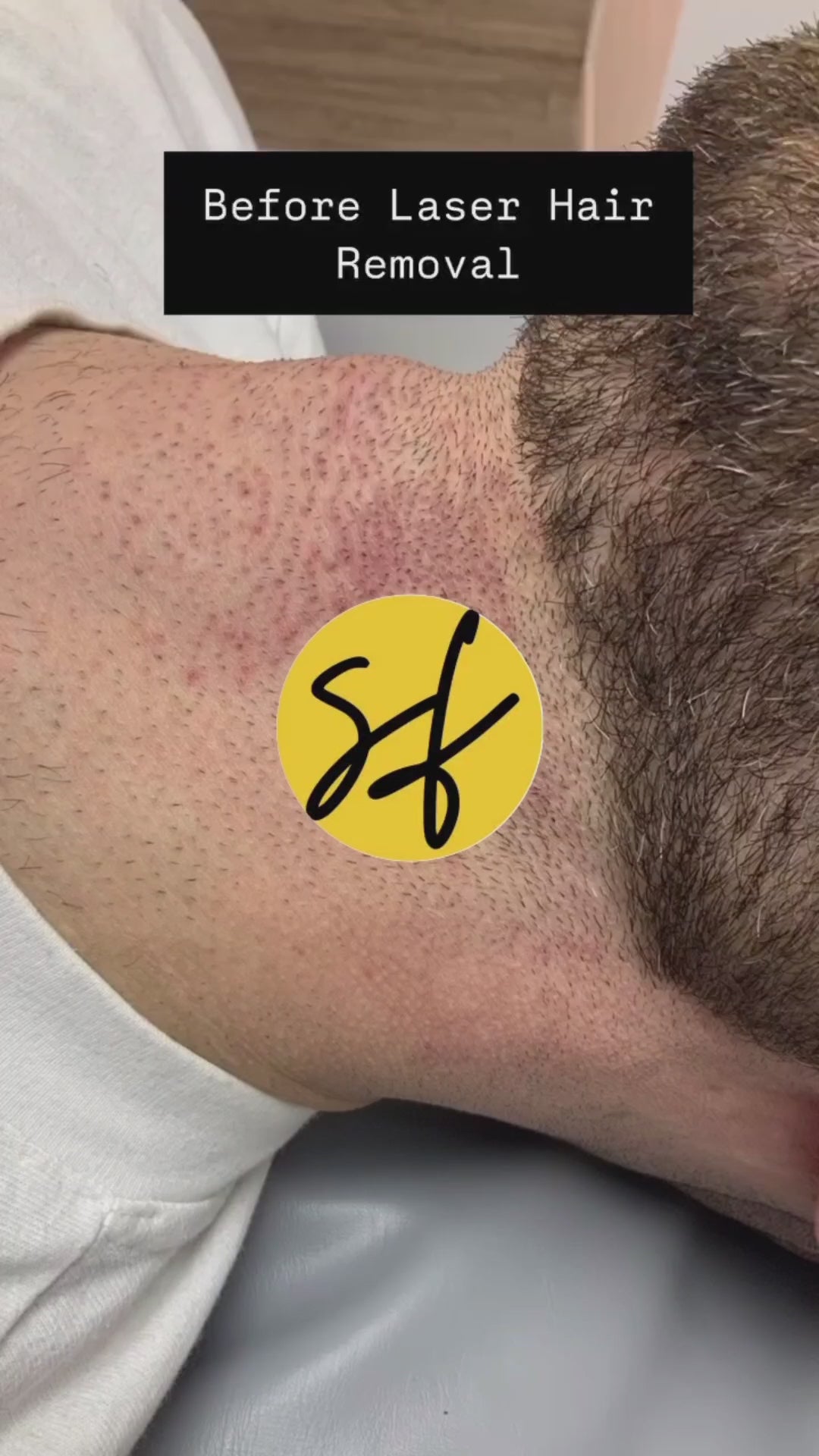 Beard Line Laser Hair Removal