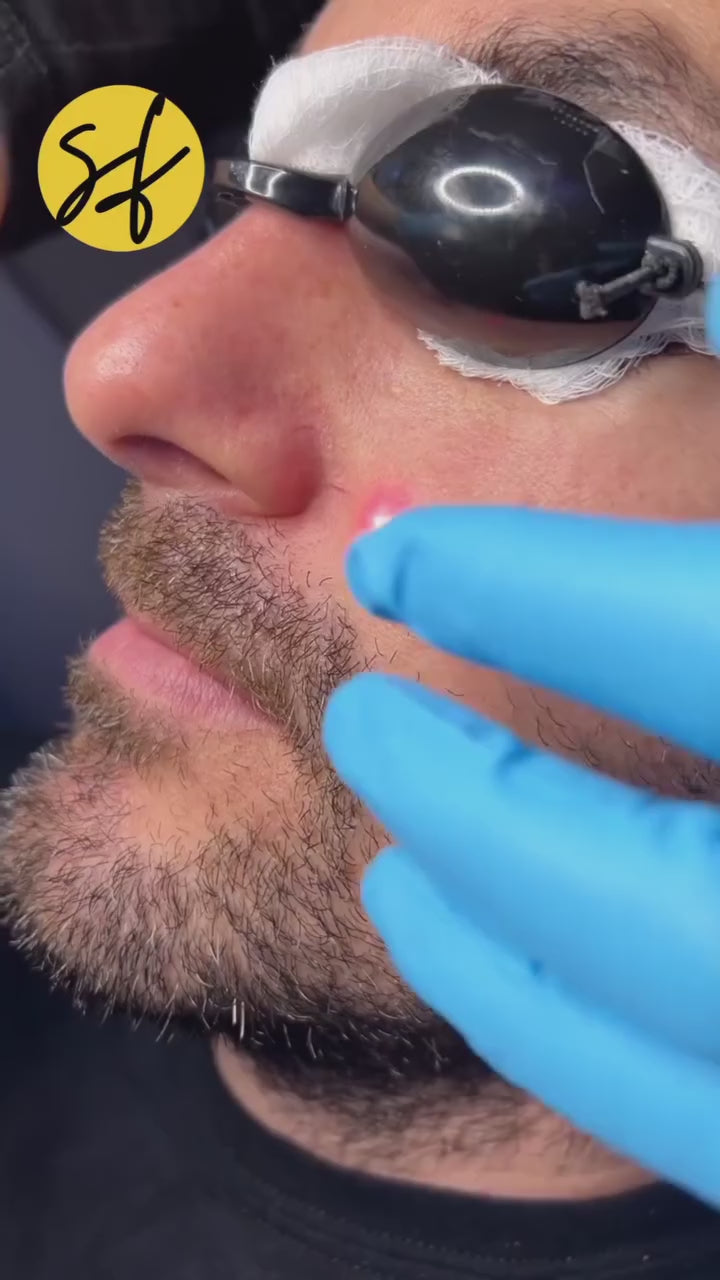 Broken Capillaries / Spider Veins Removal