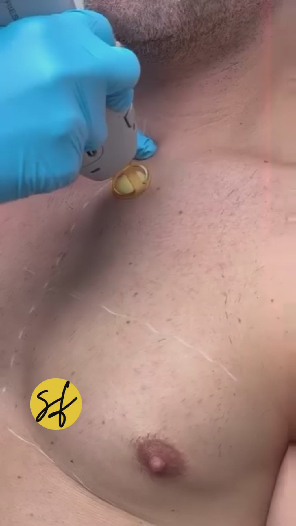 Chest Laser Hair Removal - Male