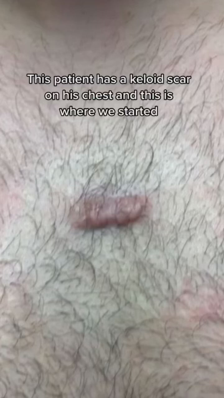 Keloid Laser Treatment