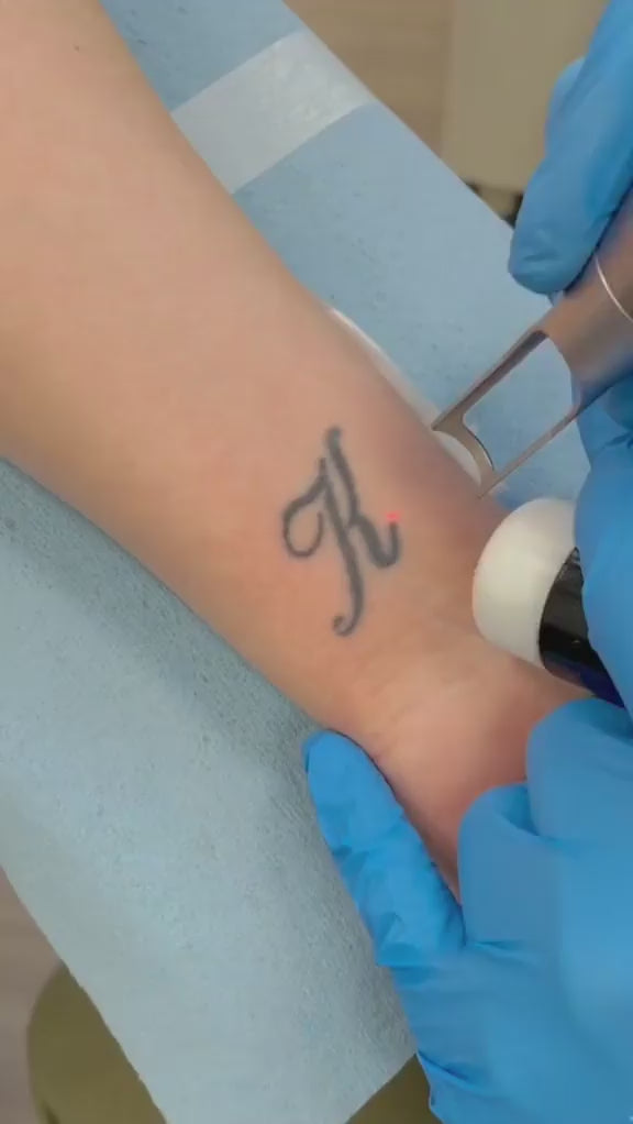 Tattoo Laser Removal