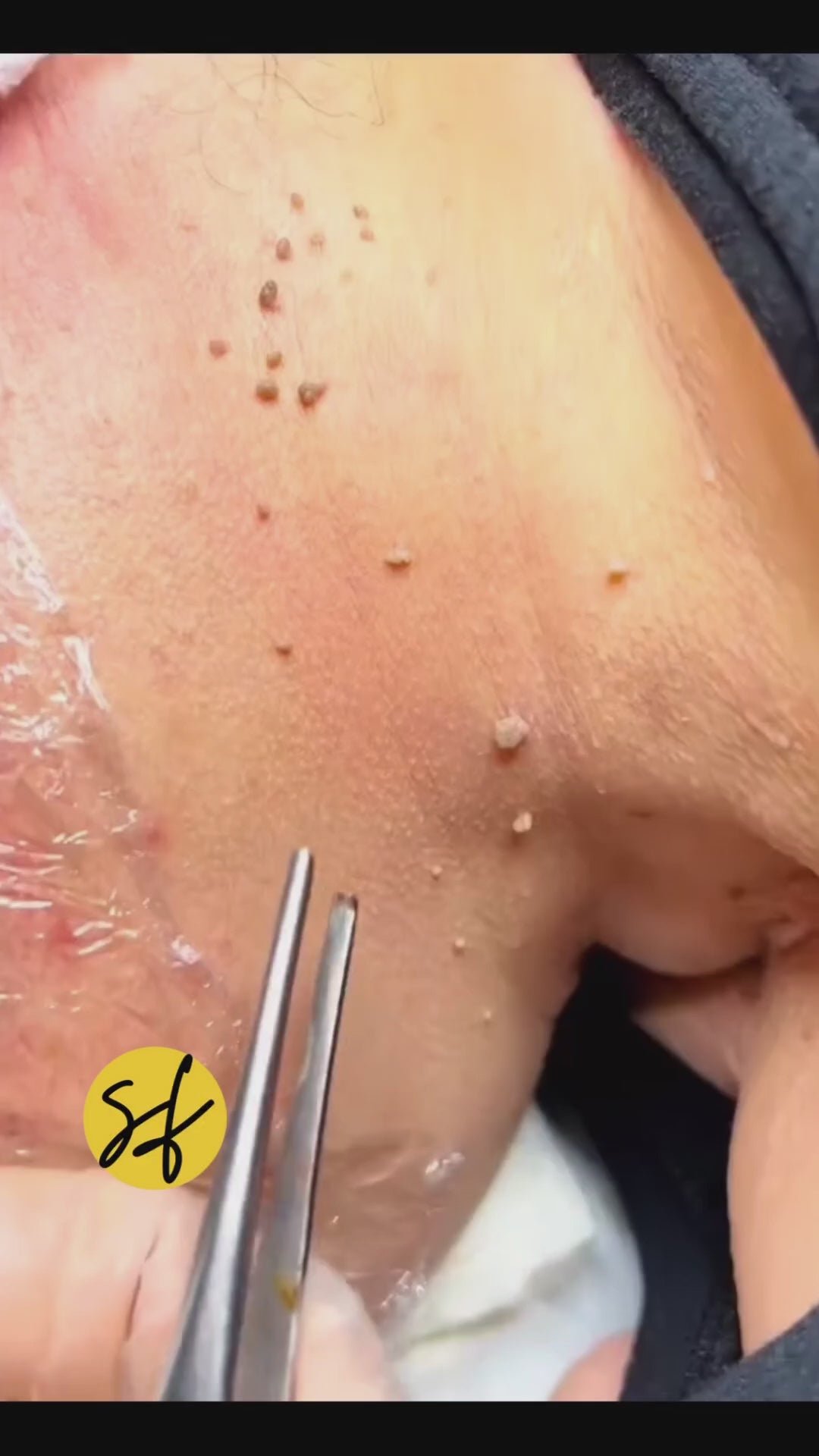 Skin Tag Removal