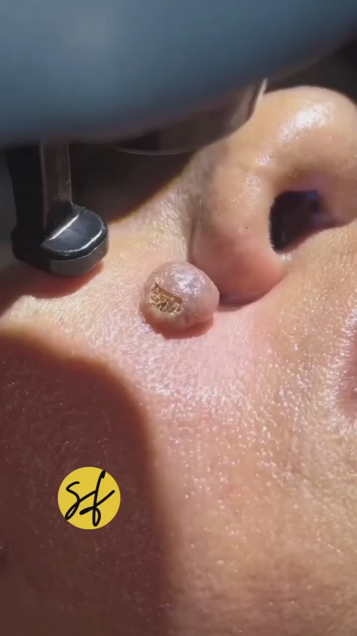 Mole Removal
