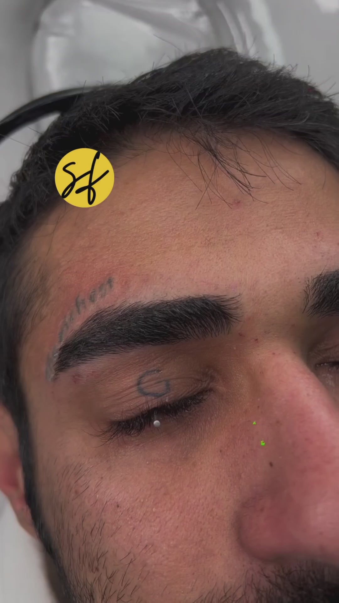 Tattoo Laser Removal