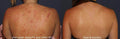 Back Acne Scar Removal Treatment - SKINFUDGE Aesthetics | Painless, No Side Effects, Natural Looking Results