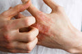 Atopic Dermatitis (Eczema) Treatment - SKINFUDGE Aesthetics | Painless, No Side Effects, Natural Looking Results
