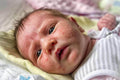Neonatal Acne - SKINFUDGE Aesthetics | Painless, No Side Effects, Natural Looking Results