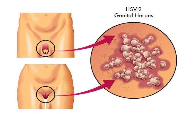 Herpes Treatment Clinic & Cost - SKINFUDGE Aesthetics | Painless, No Side Effects, Natural Looking Results