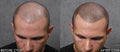 Scalp Micropigmentation (SMP) - SKINFUDGE Aesthetics | Painless, No Side Effects, Natural Looking Results