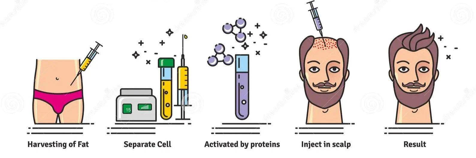 Stem Cell Treatment Therapy (Hair) - SKINFUDGE Aesthetics | Painless, No Side Effects, Natural Looking Results