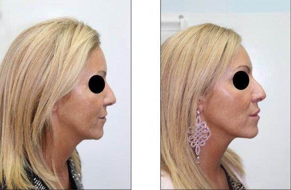 Mesobotox or Microbotox Treatment - SKINFUDGE Aesthetics | Painless, No Side Effects, Natural Looking Results