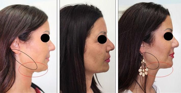 Mesobotox or Microbotox Treatment-SKINFUDGE